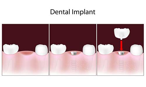 The image is a medical illustration showing the stages of dental implant treatment, from initial tooth loss to the final placement of an implant.