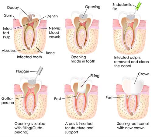 The image is a step-by-step illustration of the process to perform a dental implant surgery, showing various stages from opening the mouth and preparing the area to inserting the implant post and finalizing the procedure.