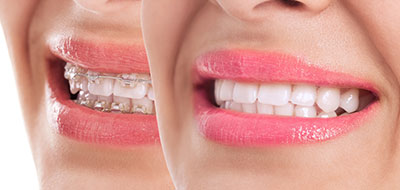 A smiling woman s face with a focus on her teeth, showcasing a dental product or service.