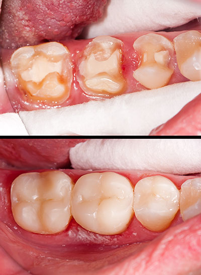 A close-up of a person s mouth showing dental work, with two images side by side highlighting the transformation from an unhealthy smile to a restored one.