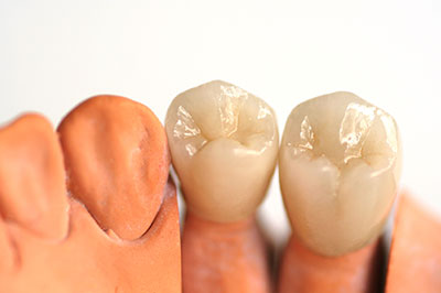 Dental implant teeth with a focus on the upper right tooth, showcasing its lifelike appearance and integration into the gumline.