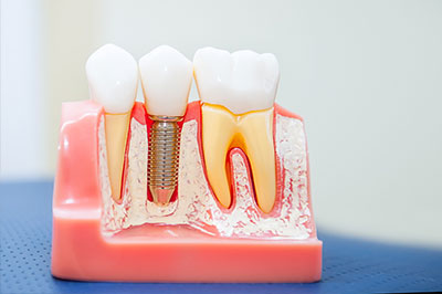 An image of a dental model displaying various dental implants and prosthetics, including a single tooth with an exposed screw, set against a pink background.