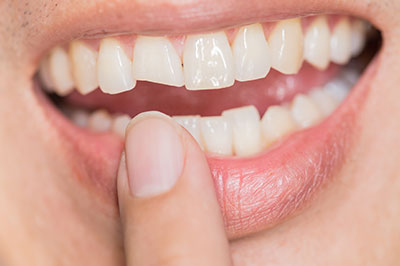 An image of a person holding a finger near their mouth, with a close-up view of their teeth and lips.