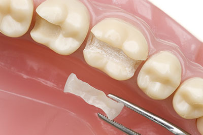 Dental implant with a toothpaste-like substance, surrounded by dental tools and a partially removed tooth.