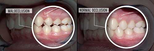 This is a split image showing two different stages of a dental implant procedure, with the left side depicting an incomplete implant and the right side showing a completed implant.