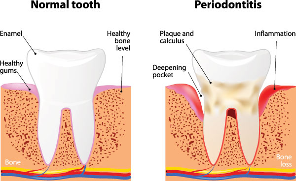 The image shows a series of cross-sectional diagrams illustrating the progression of tooth decay from normal to periodontitis, highlighting healthy bone tissue and inflammation leading to bone loss.