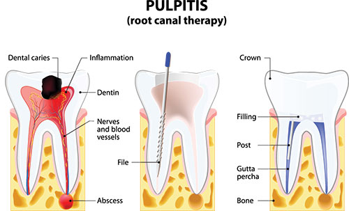 The image is a medical illustration showing the process of pulpitis, specifically focusing on dental caries and their progression to a cavity. It includes annotations explaining different stages of tooth decay, such as  Dental caries,   Inflammation,   Crown,  and  File.  The illustration is educational and uses color coding to highlight the affected areas.