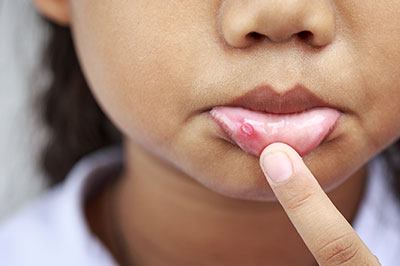 The image shows a young child with an acne treatment applied to their face, touching their nose.