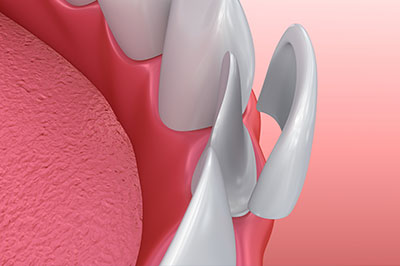 The image shows a close-up of a dental implant with a metal screw and an abutment, set against a pink background that resembles gum tissue.