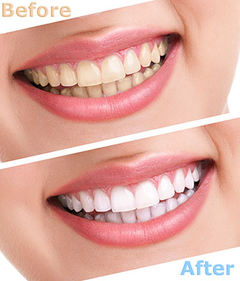 The image shows a side-by-side comparison of a person s teeth before and after professional teeth whitening, highlighting the dramatic improvement in brightness and cleanliness.