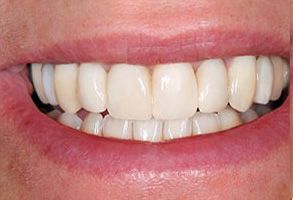 A close-up of a person s smile showcasing straight, white teeth and a pink tongue.