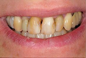 The image shows a close-up of a person s teeth with visible staining and discoloration, emphasizing dental health concerns.